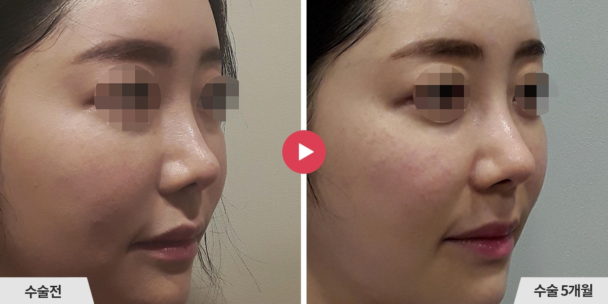 코재수술+비순각교정+진피이식