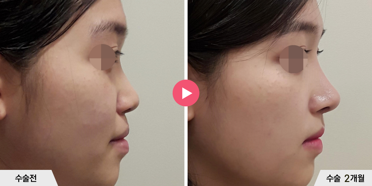 코성형+절골+진피이식