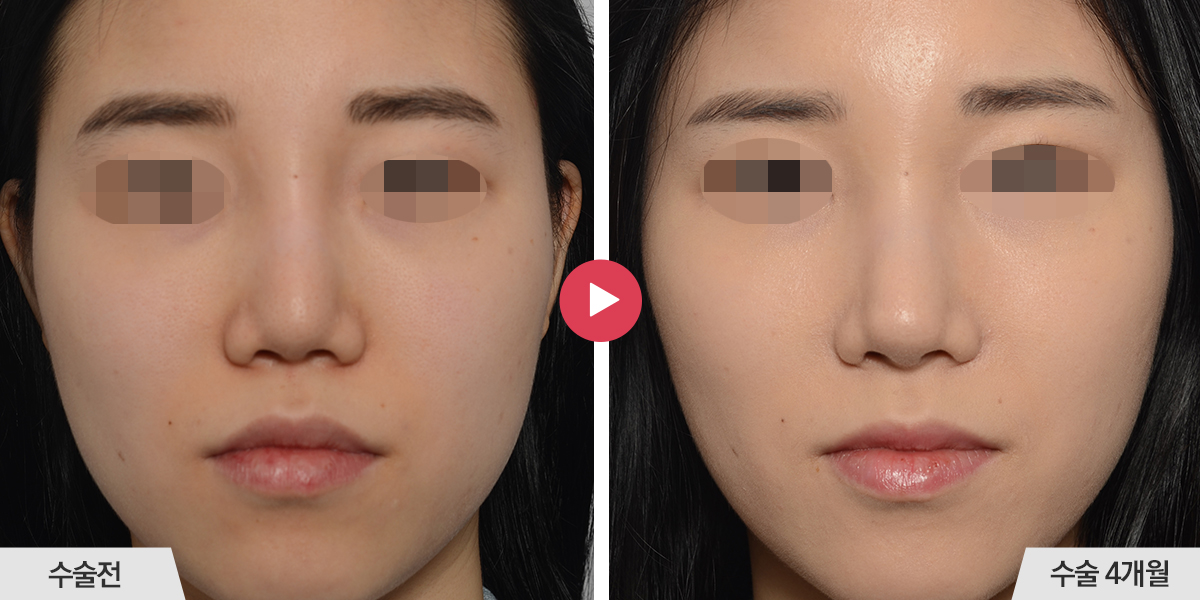 콧등이 너무 높은 경우