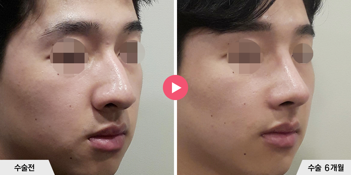 매부리코성형+절골+콧볼축소+귀족수술+비중격만곡증교정