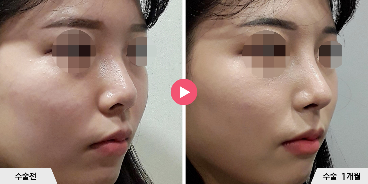 코성형+비주빼기+진피이식