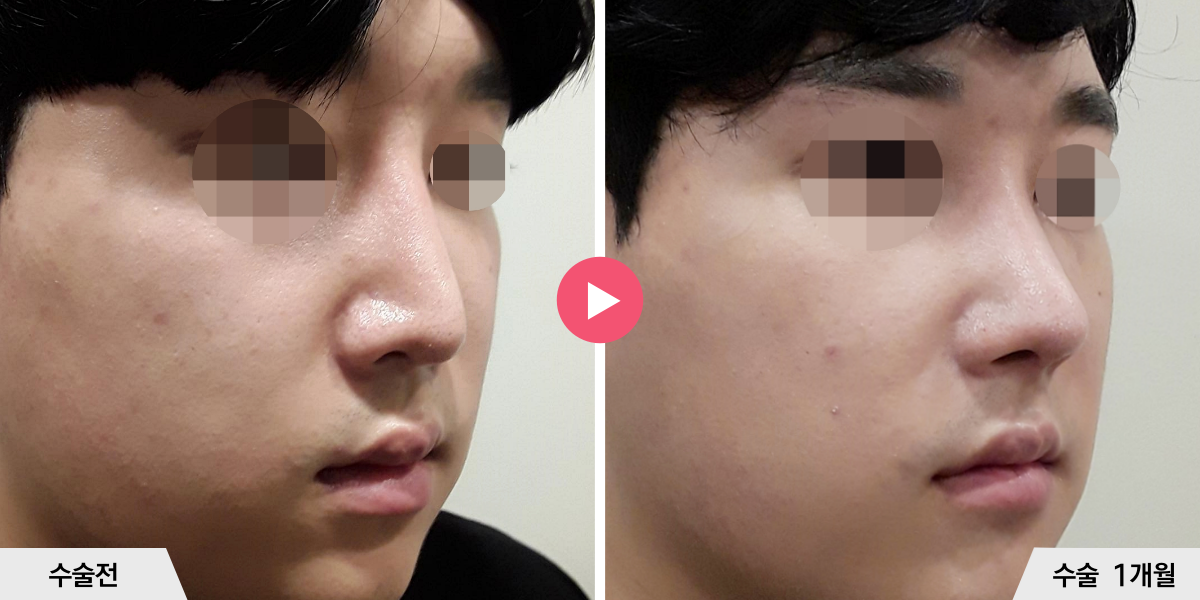 코재수술+비순각교정+진피이식