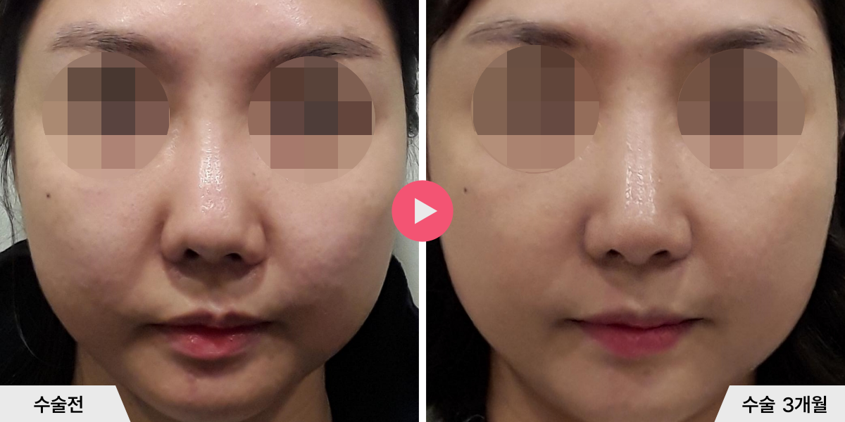 코재수술+절골+비공내리기+비중격만곡증교정