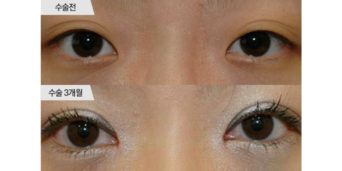 쌍꺼풀 수술, 절개법 & 앞트임 수술