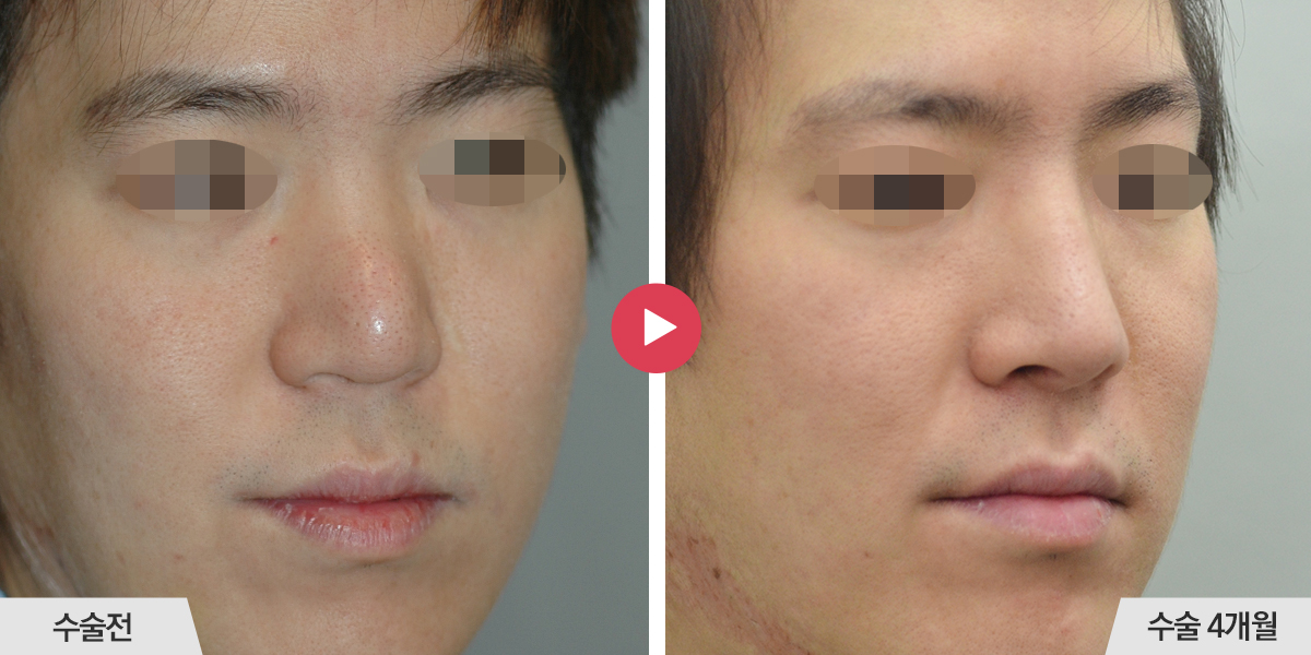 콧등이 매끄럽지 않거나 코끝과의 경계가 표시나는 경우