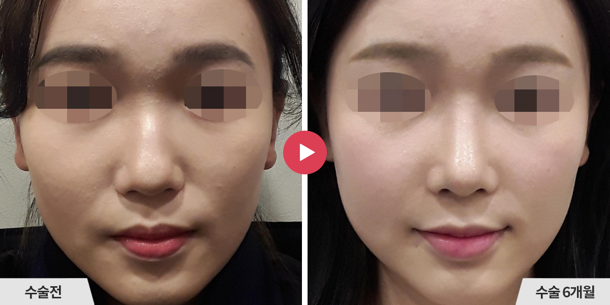 매부리코성형+비순각교정+진피이식+귀족수술