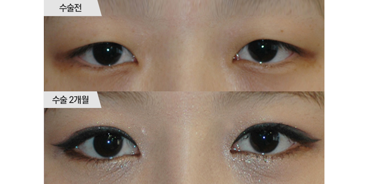 쌍꺼풀 수술, 매몰법 & 앞트임 수술