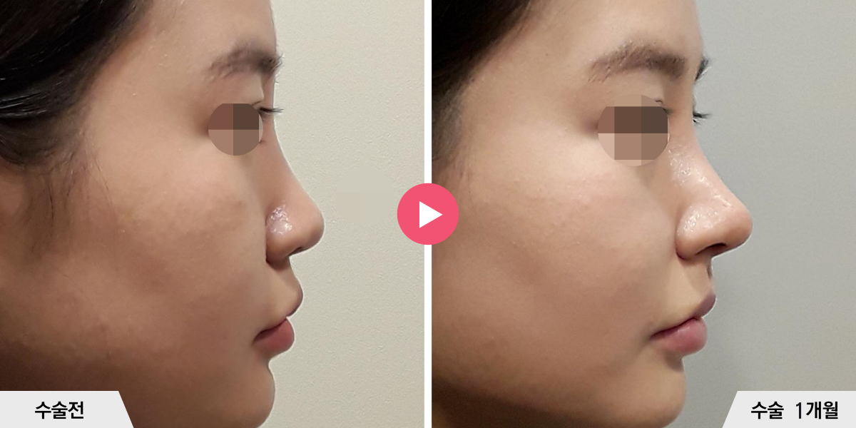 코성형+비순각교정+진피이식