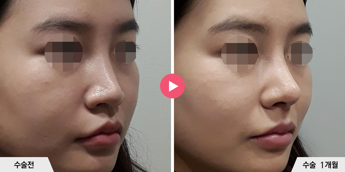 코성형+비순각교정+진피이식