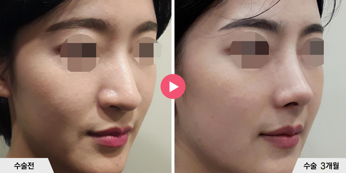 코성형+절골+비순각교정