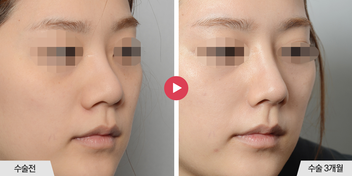 코끝이 뭉툭한 경우(복코 재수술)