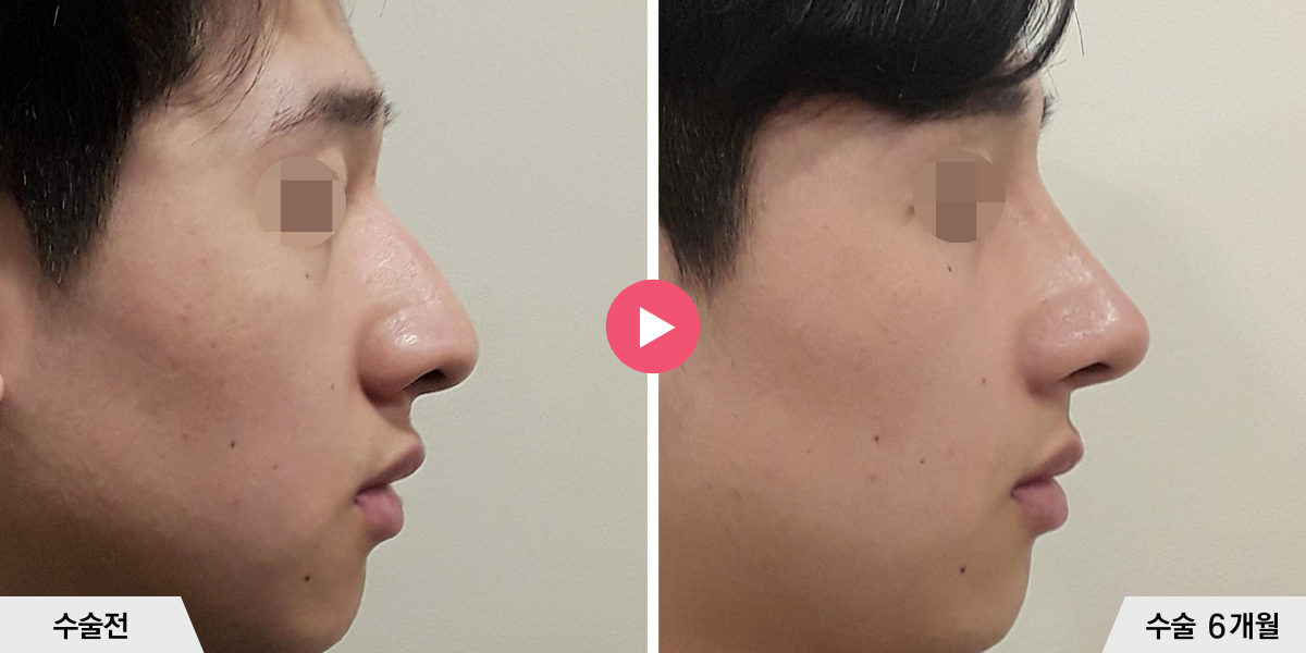 매부리코성형+절골+콧볼축소+귀족수술+비중격만곡증교정