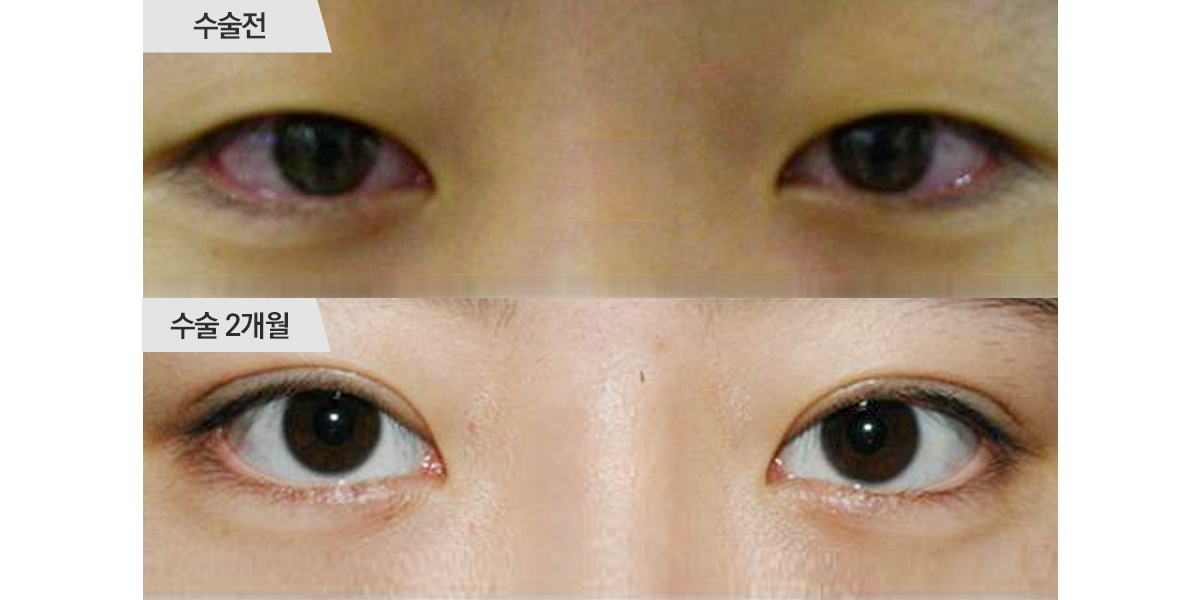 쌍꺼풀 수술, 매몰법 & 앞트임 수술