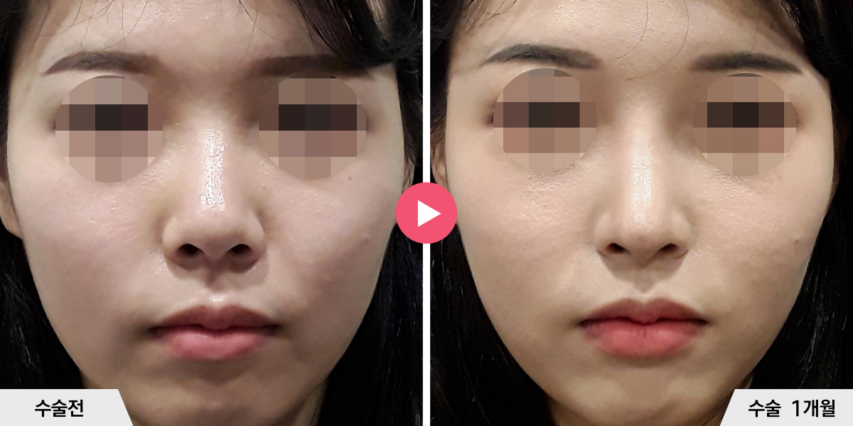 코성형+비주빼기+진피이식