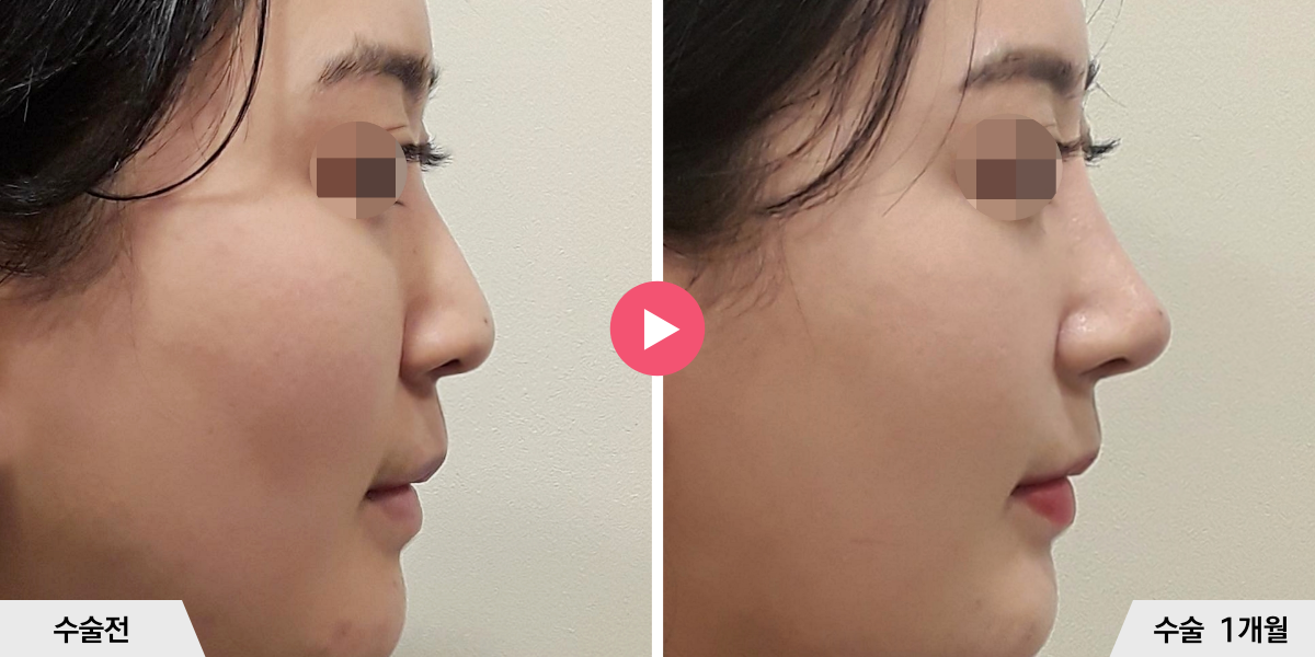 코성형+비순각교정+진피이식+콧볼축소+귀족수술