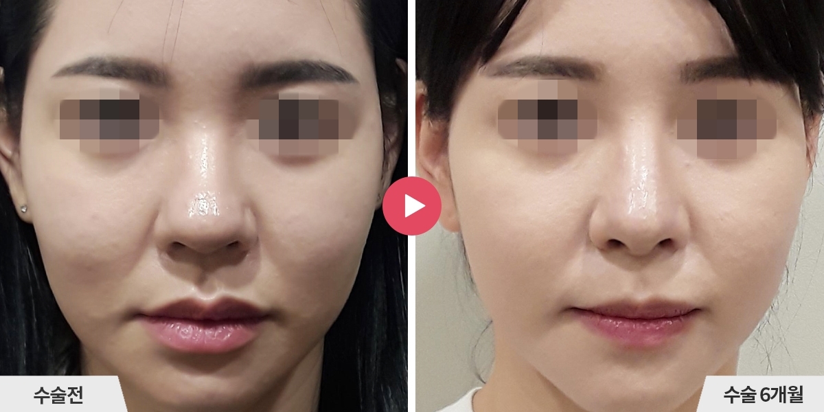 코성형+비순각교정