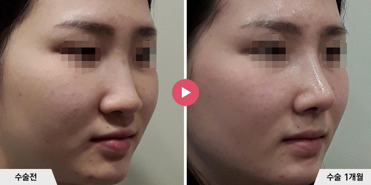 코성형+비순각교정