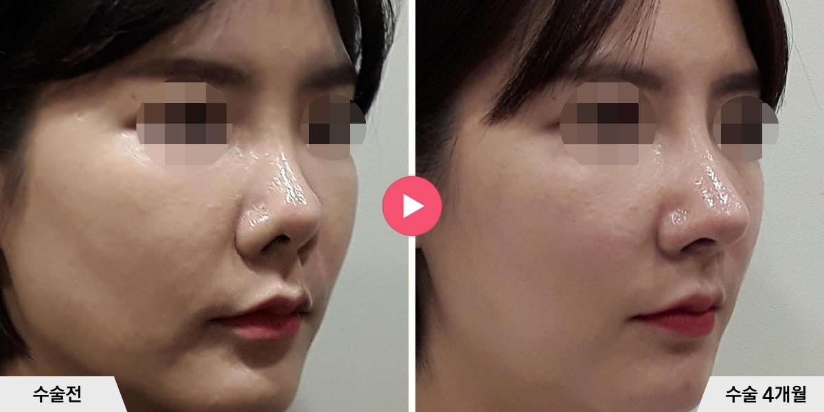 코재수술+절골+비공내리기