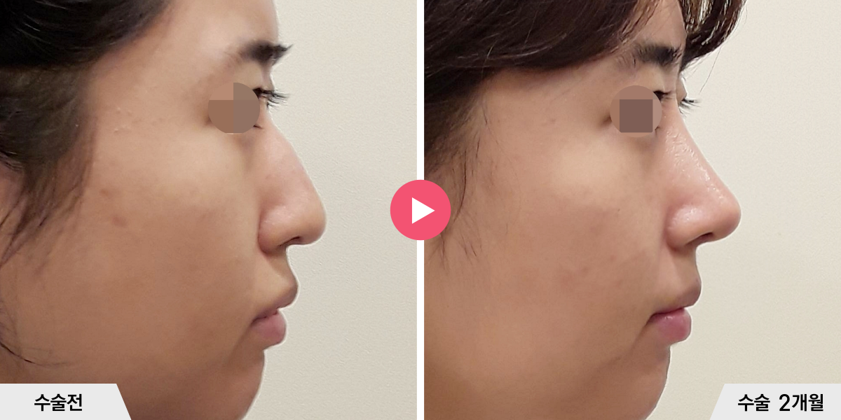 매부리코성형+절골+비중격만곡증교정