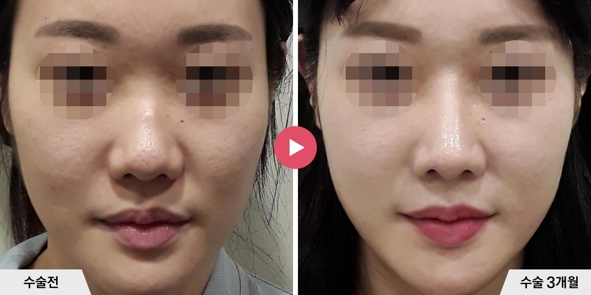 매부리코성형+절골