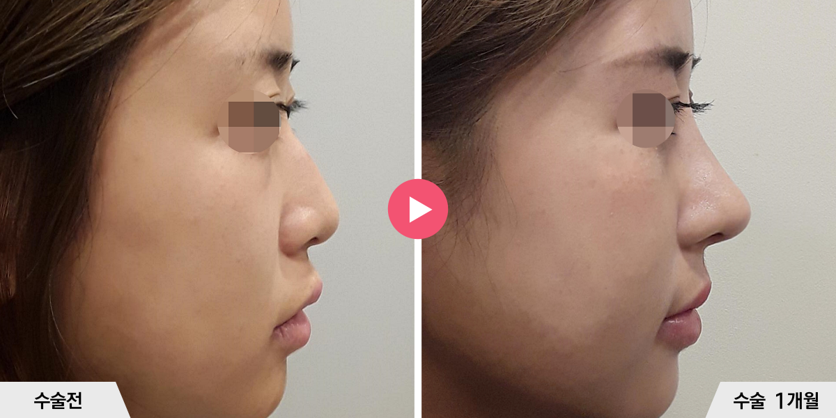 매부리코성형+절골+진피이식