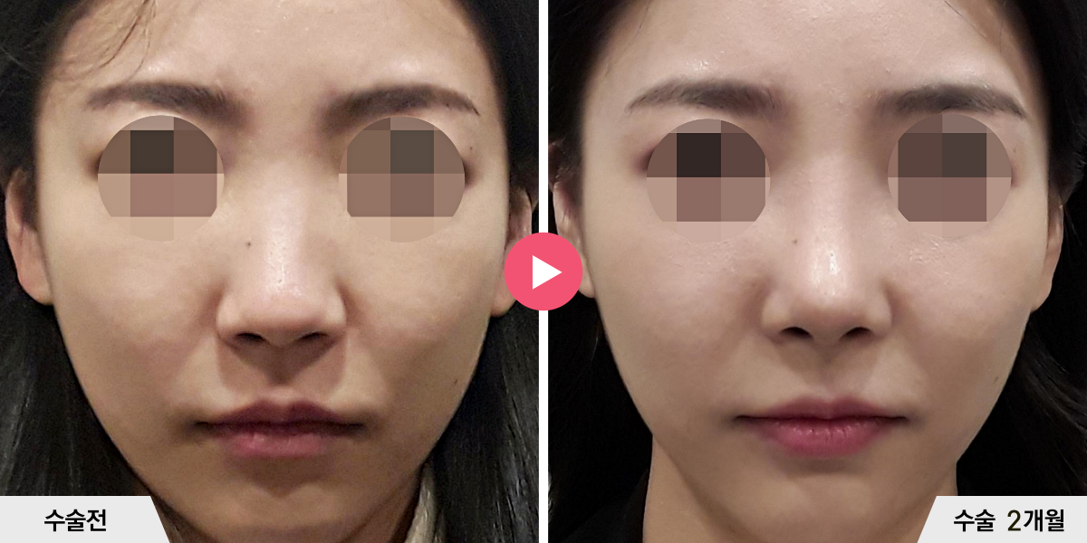 코성형+절골+비중격만곡증교정