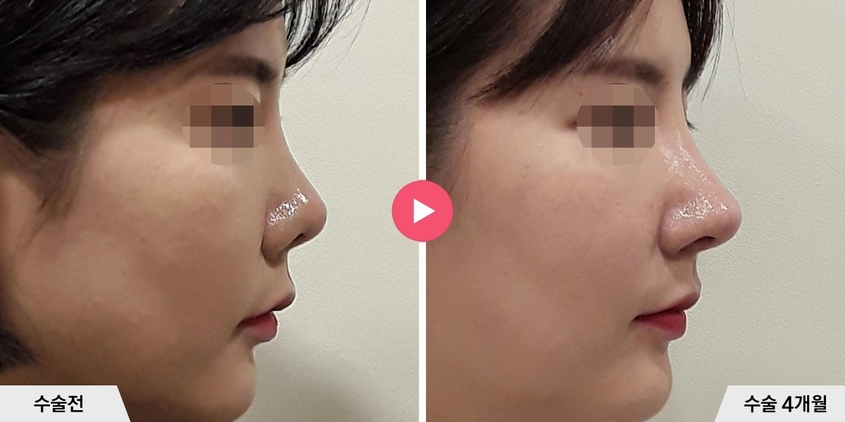 코재수술+절골+비공내리기