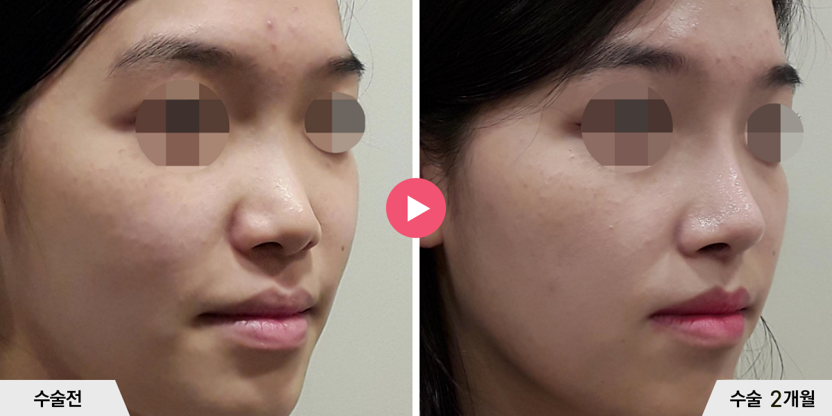 코성형+절골+진피이식