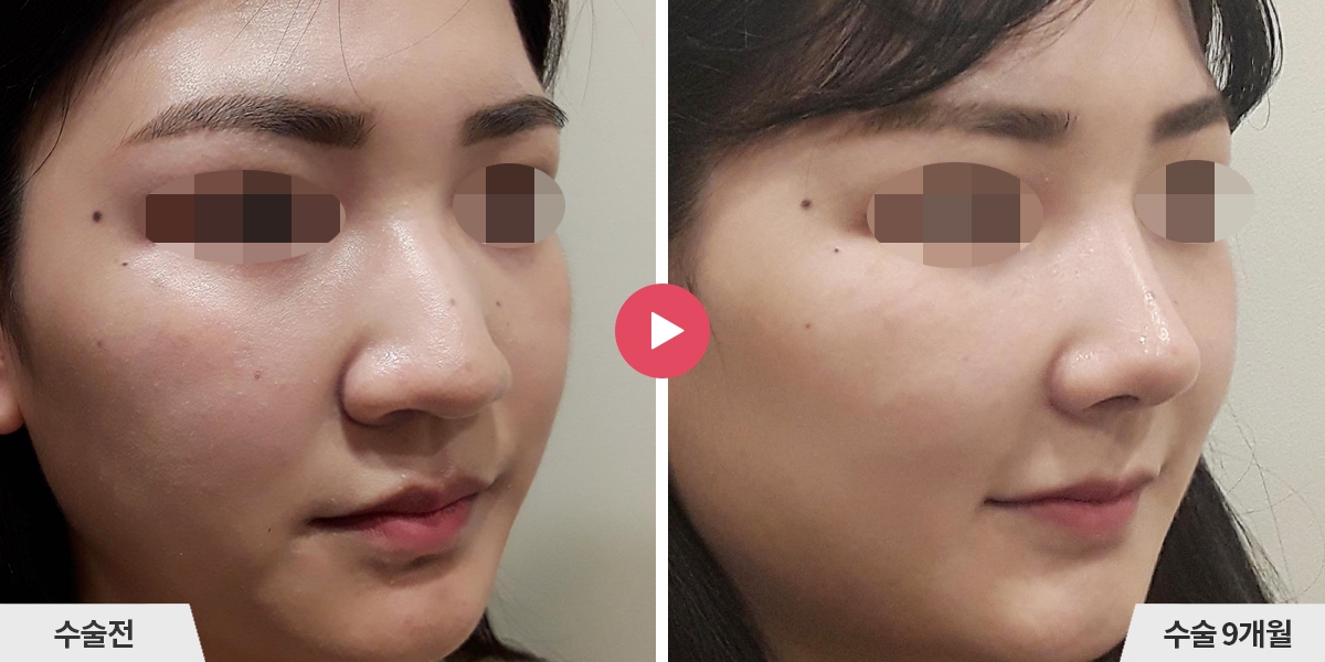 복코성형+비순각교정+콧볼축소+귀족수술