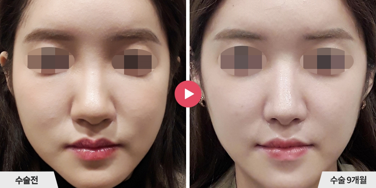 코성형+비순각교정+콧볼축소+귀족수술