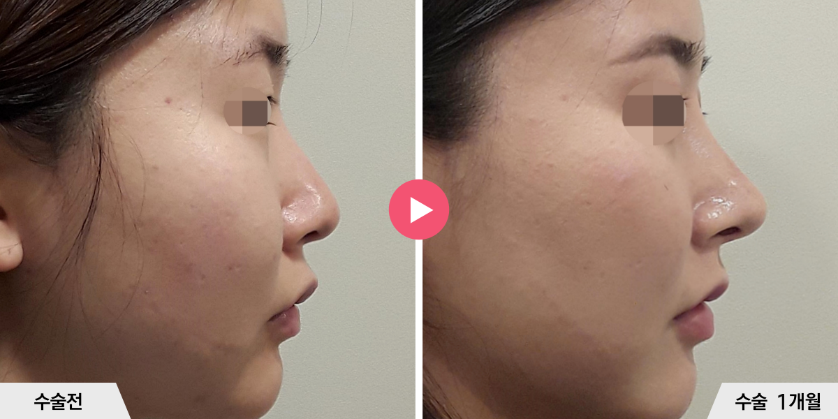 코성형+비순각교정+진피이식