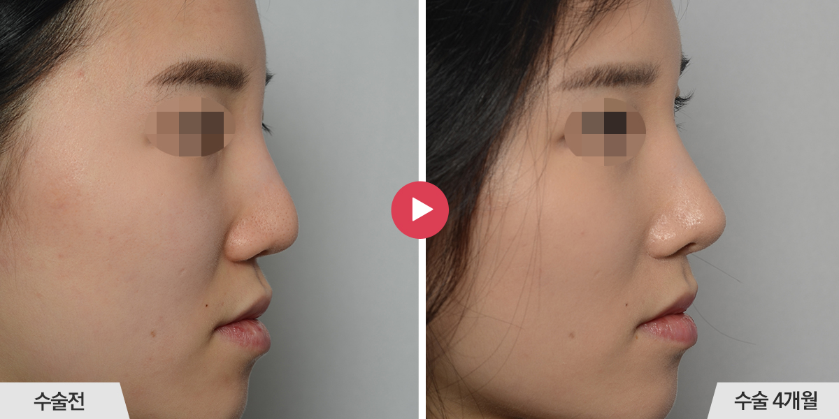 콧등이 너무 높은 경우