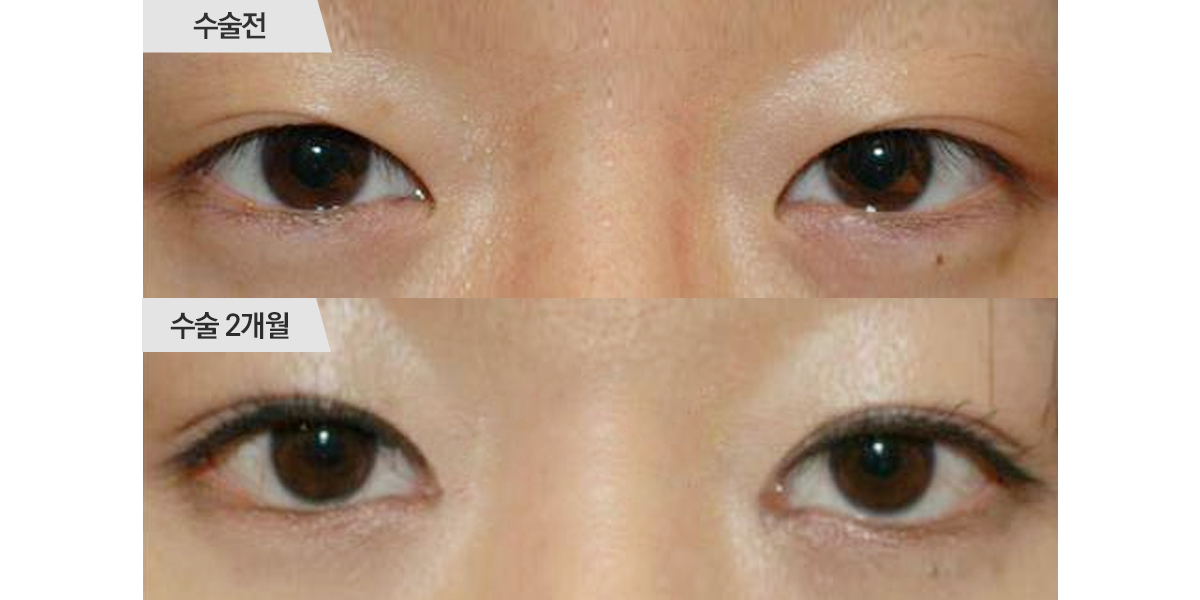 쌍꺼풀 수술, 매몰법 & 앞트임 수술