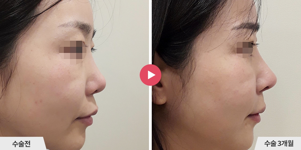 자가늑코재수술+비순각교정+진피이식+귀족수술