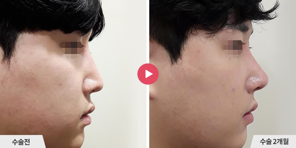 코재수술+절골+비순각교정+진피이식