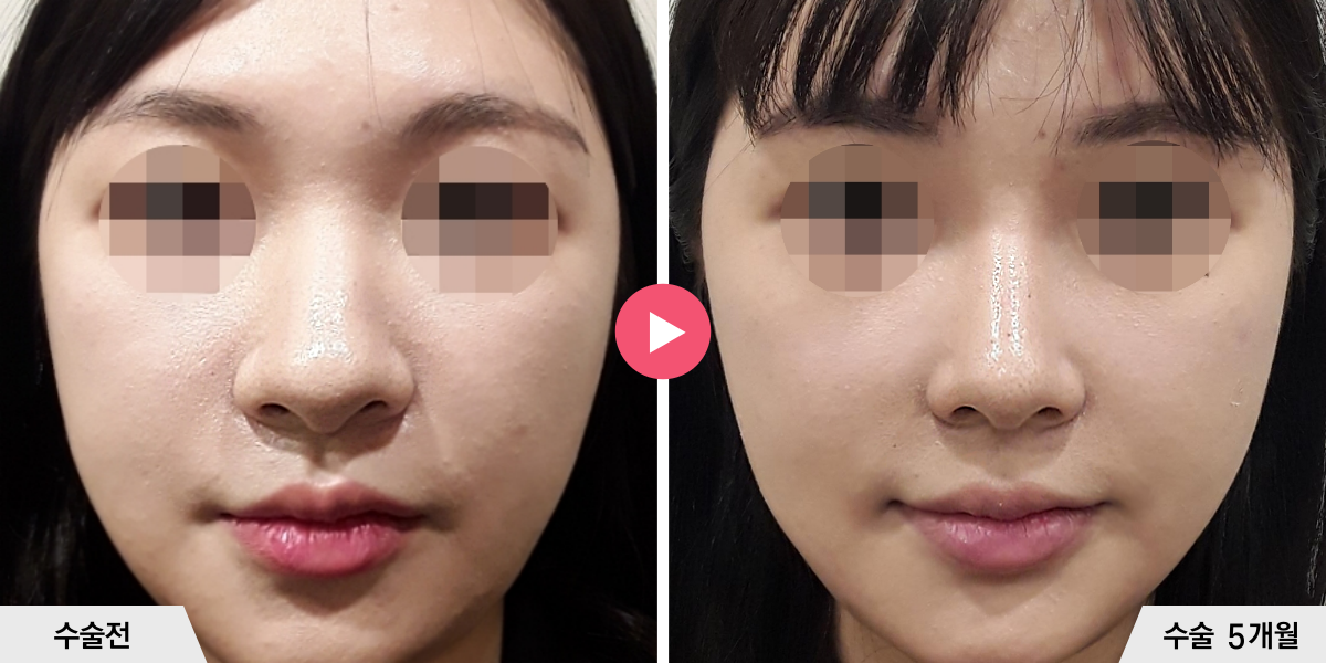 코성형+절골+콧볼축소