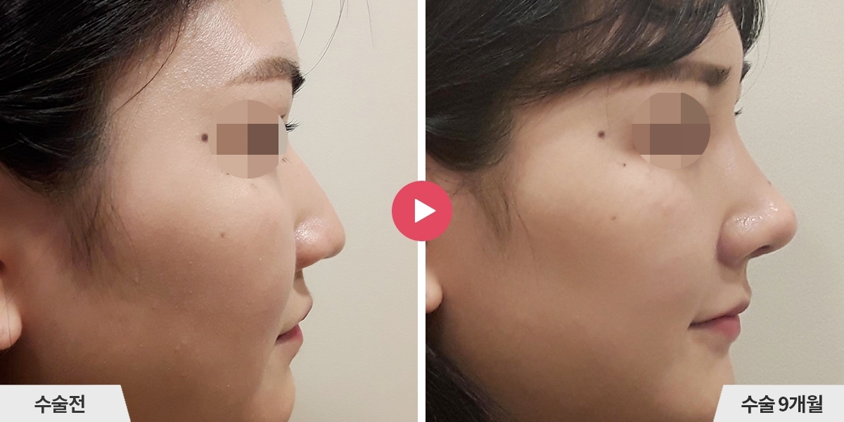 복코성형+비순각교정+콧볼축소+귀족수술
