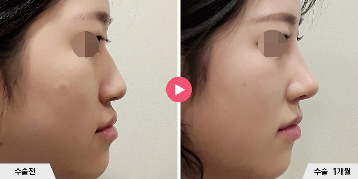 매부리코성형+절골+비순각교정+진피이식