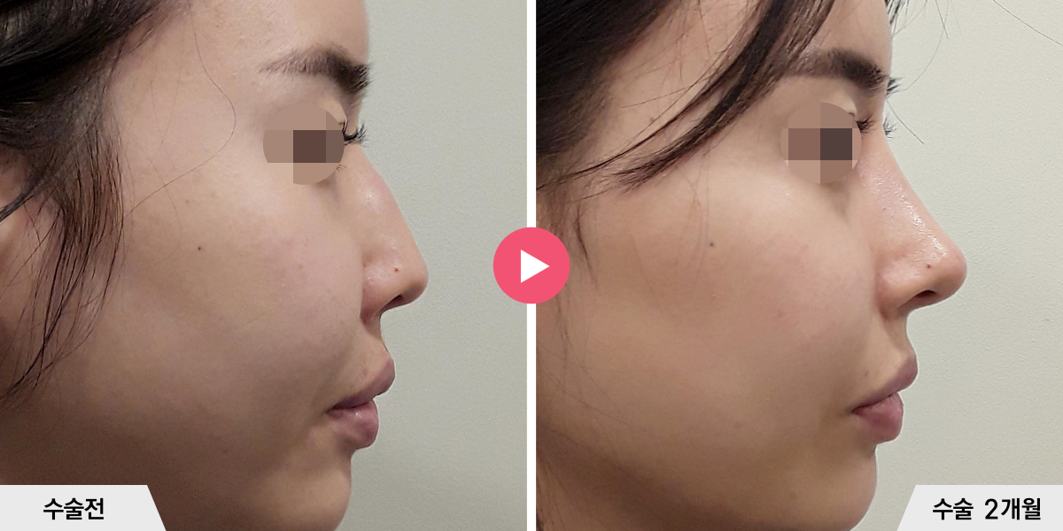 매부리코성형+절골+진피이식