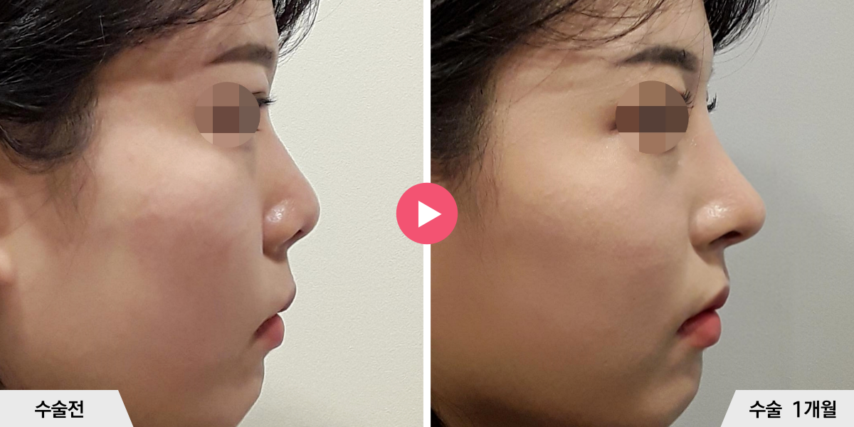 코성형+비주빼기+진피이식