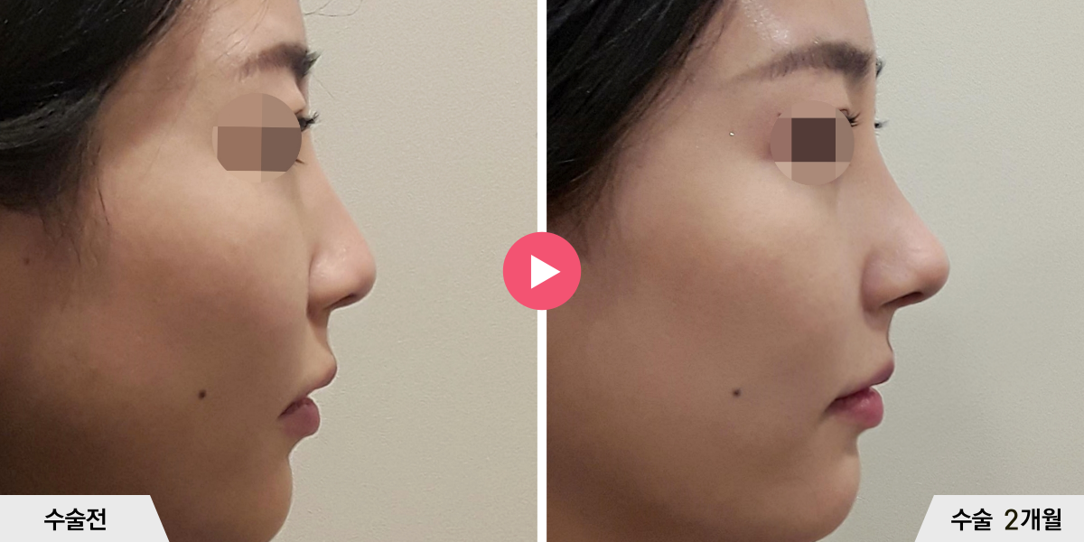 코성형+절골+비중격만곡증교정