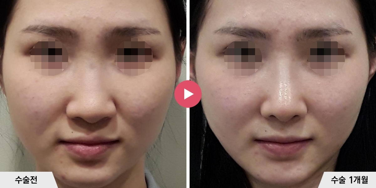 코성형+비순각교정