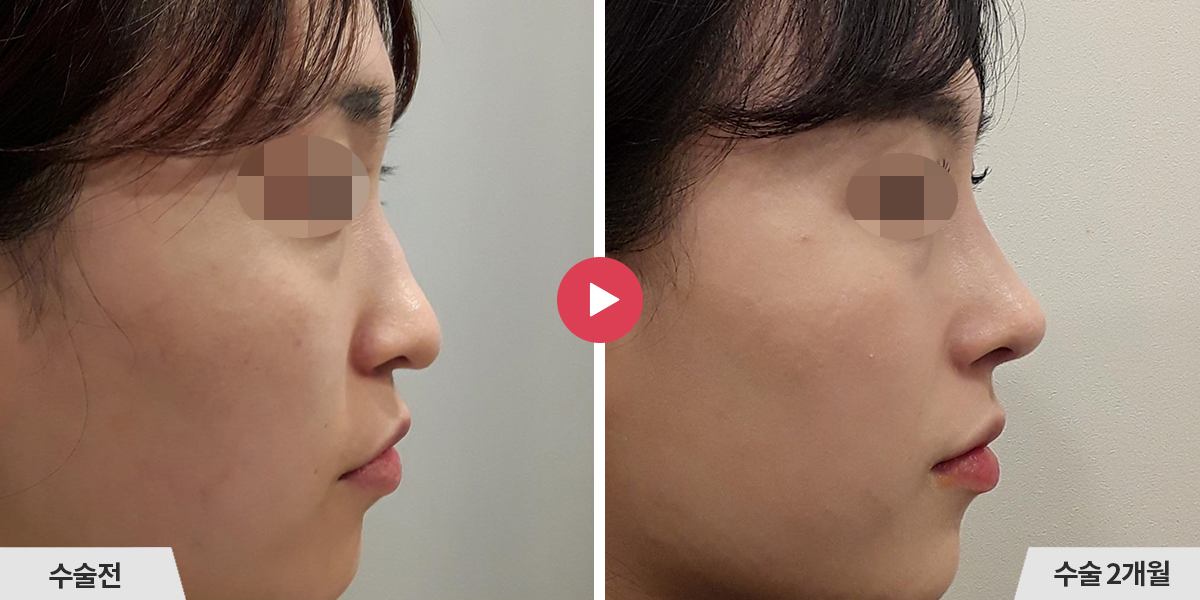 코성형+진피이식+비중격만곡증교정