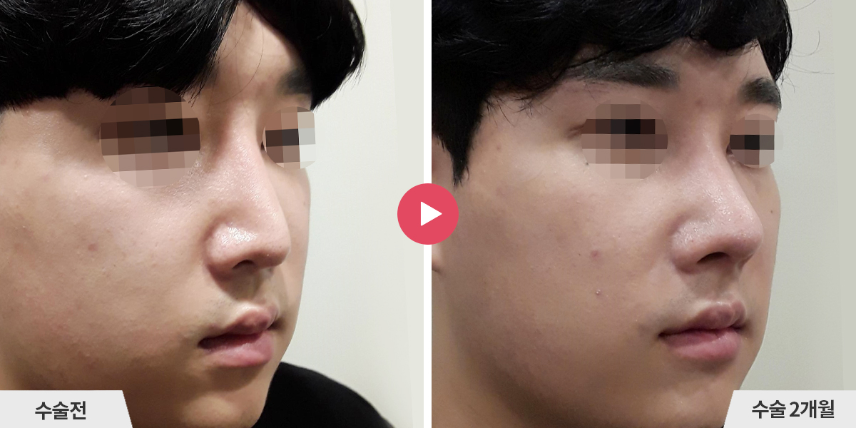 코재수술+절골+비순각교정+진피이식