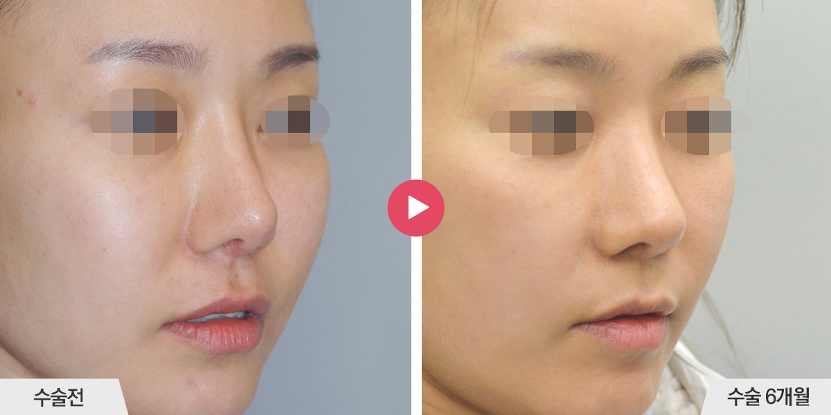 콧등이 넓거나 비대칭인 경우