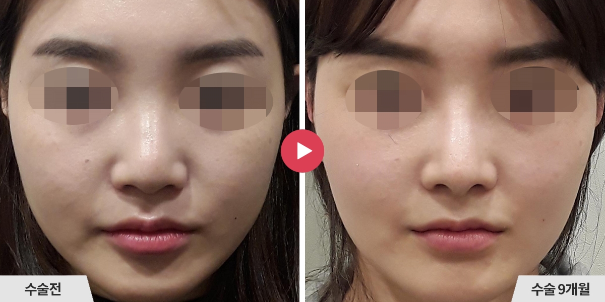 코성형+절골+비순각교정+진피이식