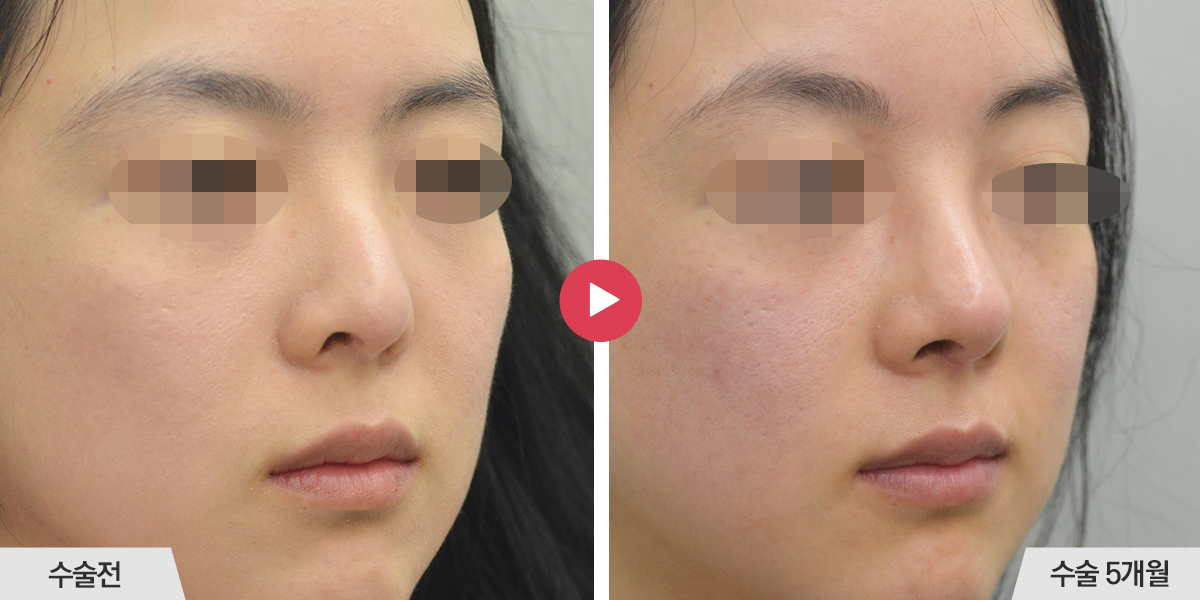 콧등이 매끄럽지 않거나 코끝과의 경계가 표시나는 경우