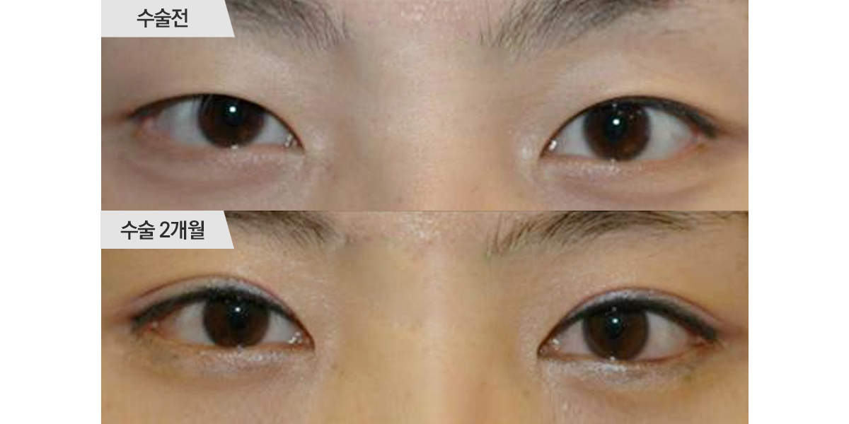 쌍꺼풀 수술, 매몰법 & 앞트임 수술