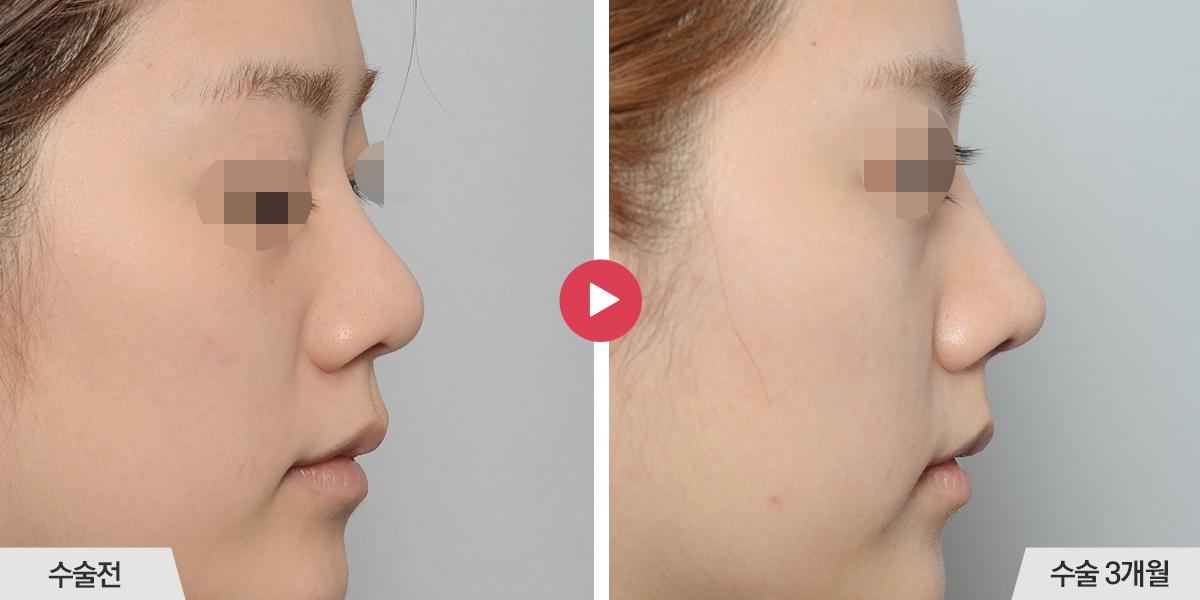 코끝이 뭉툭한 경우(복코 재수술)