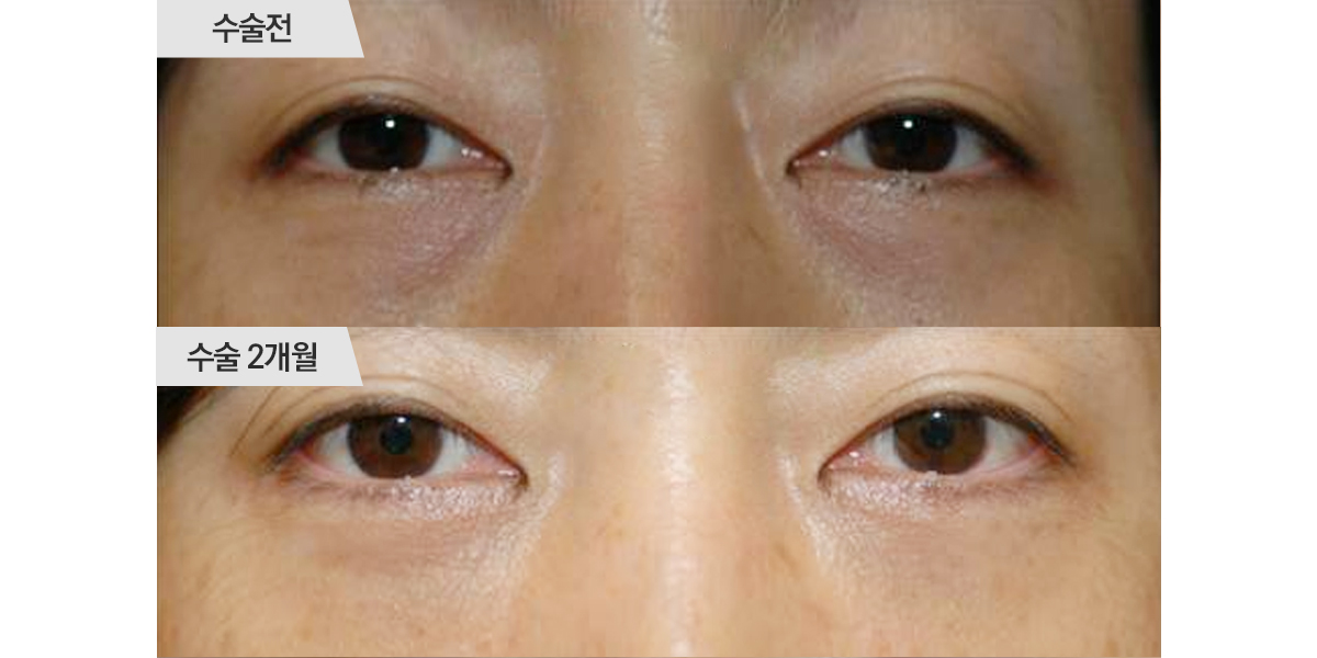 눈 밑 지방 이동